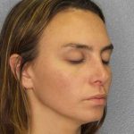 Rhinoplasty Before & After Patient #9746