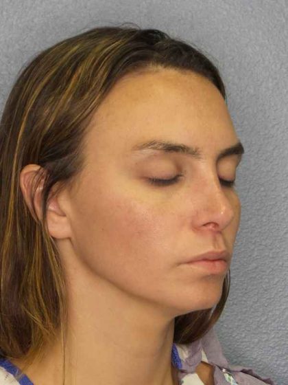 Rhinoplasty Before & After Patient #9746