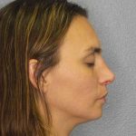 Rhinoplasty Before & After Patient #9746