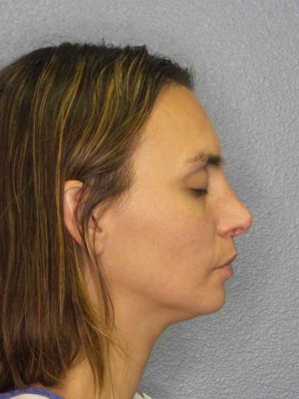 Rhinoplasty Before & After Patient #9746