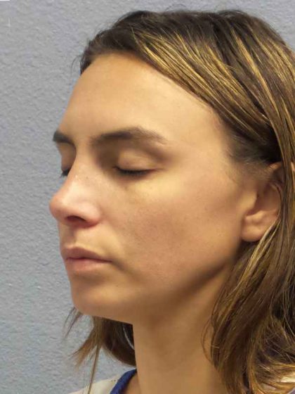 Rhinoplasty Before & After Patient #9746