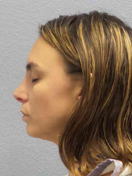 Rhinoplasty Before & After Patient #9746