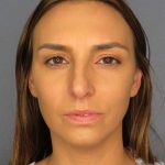 Rhinoplasty Before & After Patient #9746