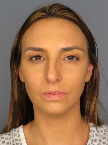 Rhinoplasty Before & After Patient #9746