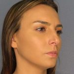 Rhinoplasty Before & After Patient #9746