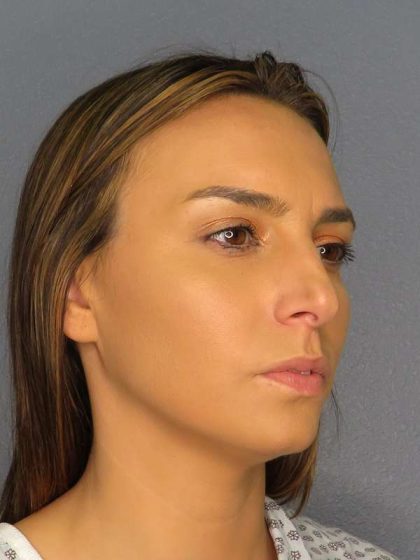 Rhinoplasty Before & After Patient #9746