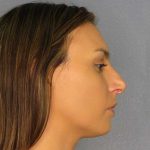 Rhinoplasty Before & After Patient #9746