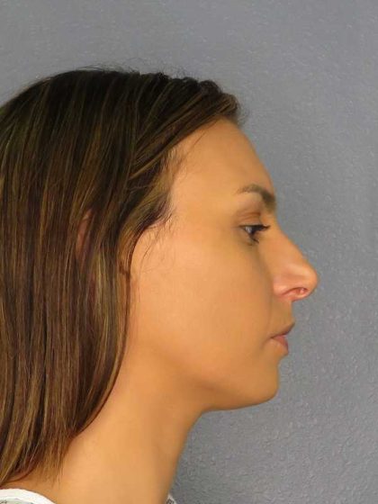 Rhinoplasty Before & After Patient #9746