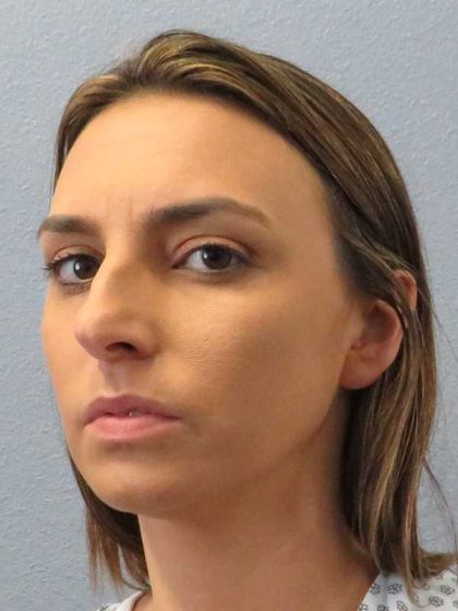 Rhinoplasty Before & After Patient #9746