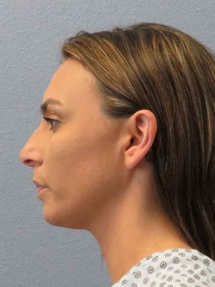 Rhinoplasty Before & After Patient #9746