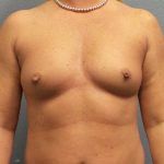 Liposuction Female Before & After Patient #7824