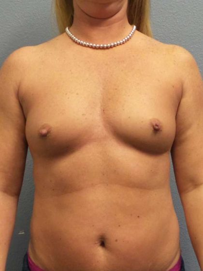 Liposuction Female Before & After Patient #7824
