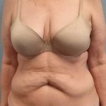 Abdominoplasty Before & After Patient #3528