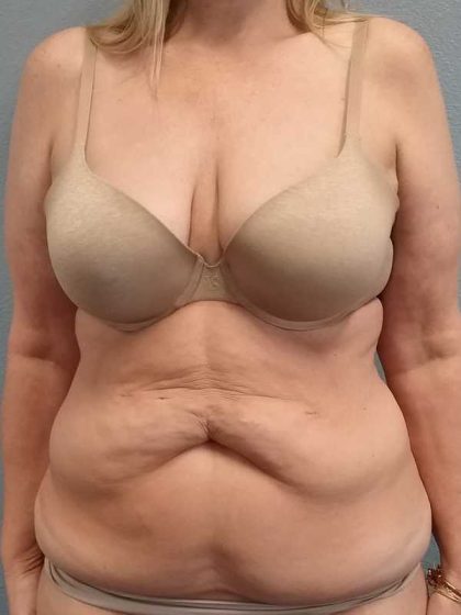 Abdominoplasty Before & After Patient #3528