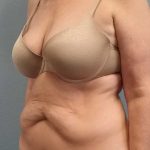 Abdominoplasty Before & After Patient #3528
