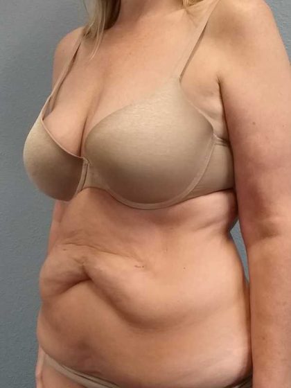 Abdominoplasty Before & After Patient #3528