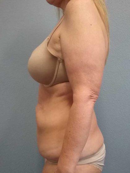 Abdominoplasty Before & After Patient #3528