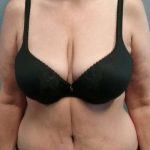 Abdominoplasty Before & After Patient #3528