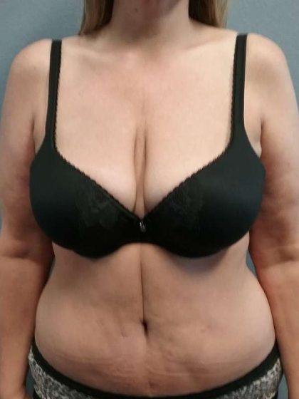 Abdominoplasty Before & After Patient #3528
