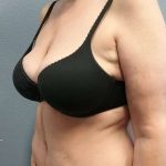 Abdominoplasty Before & After Patient #3528