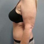 Abdominoplasty Before & After Patient #3528