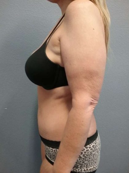 Abdominoplasty Before & After Patient #3528