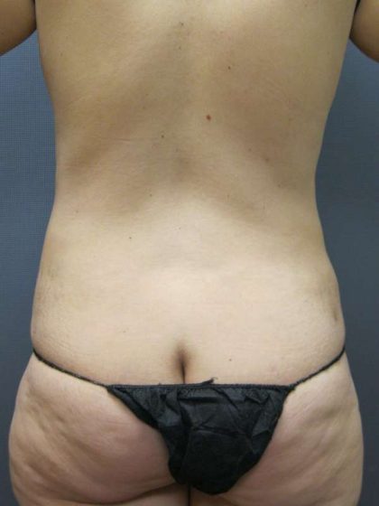 Liposuction Female Before & After Patient #7854