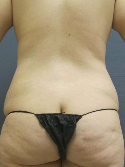 Liposuction Female Before & After Patient #7854