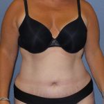 Liposuction Female Before & After Patient #7687