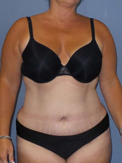 Liposuction Female Before & After Patient #7687