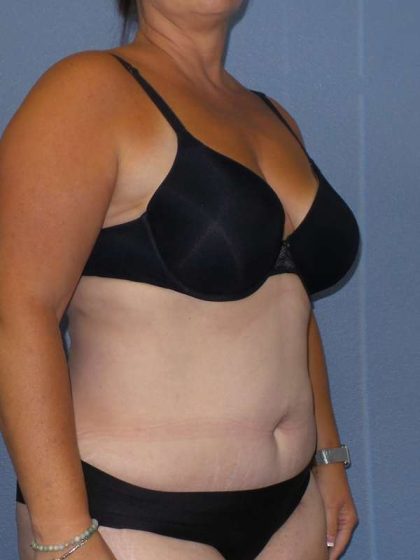 Liposuction Female Before & After Patient #7687