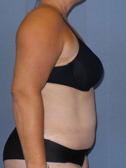 Liposuction Female Before & After Patient #7687