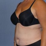Liposuction Female Before & After Patient #7687