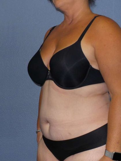 Liposuction Female Before & After Patient #7687