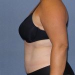 Liposuction Female Before & After Patient #7687