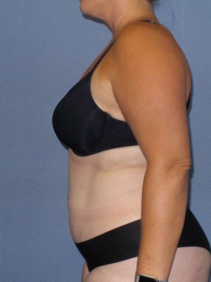 Liposuction Female Before & After Patient #7687