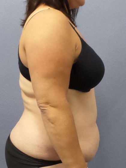 Liposuction Female Before & After Patient #7687