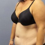 Liposuction Female Before & After Patient #7687