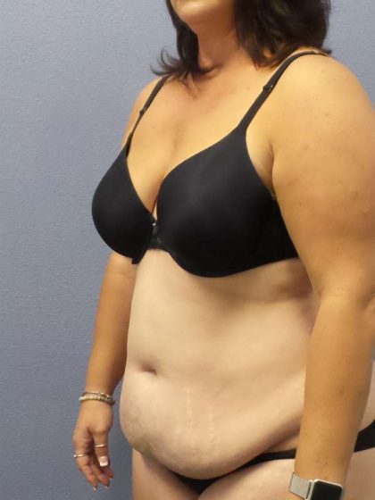 Liposuction Female Before & After Patient #7687