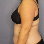 Liposuction Female Before & After Patient #7687