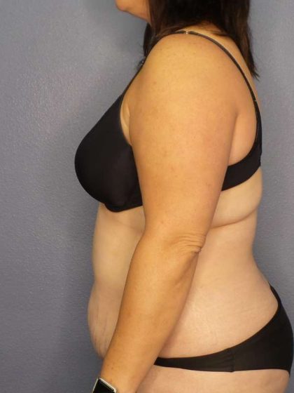 Liposuction Female Before & After Patient #7687