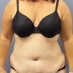 Liposuction Female Before & After Patient #7687