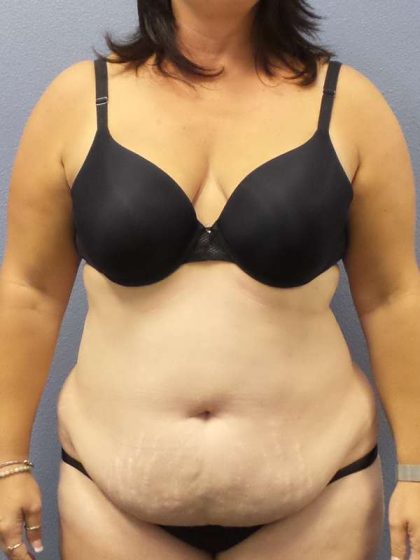 Liposuction Female Before & After Patient #7687