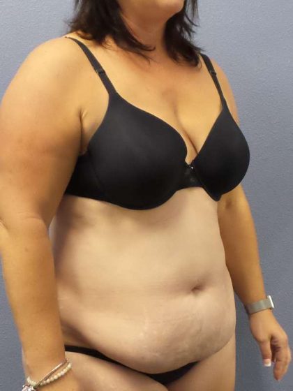 Liposuction Female Before & After Patient #7687