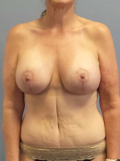 Augmentation Mastopexy Revision Before & After Patient #4697