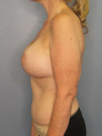 Augmentation Mastopexy Revision Before & After Patient #4697