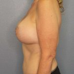 Breast Lift with Implant (Augmentation Mastopexy) Before & After Patient #4231