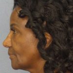 Rhinoplasty Before & After Patient #9893