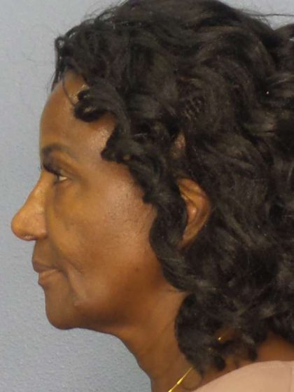 Rhinoplasty Before & After Patient #9893