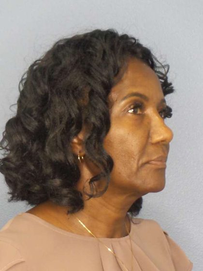 Rhinoplasty Before & After Patient #9893